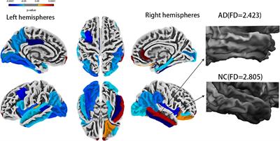 Machine learning models for diagnosing Alzheimer’s disease using brain cortical complexity